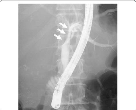 Endoscopic Retrograde Cholangiography Erc Shows Compression Of The