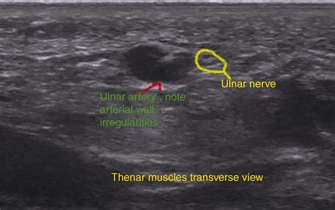 Injection Technique For Ulnar Tunnel Syndrome Clinical Tree