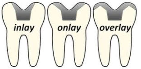 Inlays Onlays E Overlays - Incrustaciones dentales: inlays, onlays, overlays y adhesión dental ...