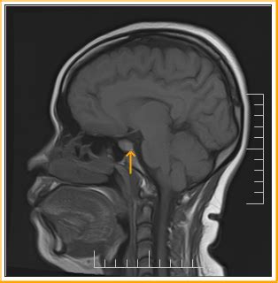 Rathke's Cleft Cyst :MRI - Sumer's Radiology Blog