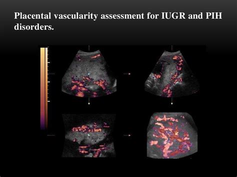 3 D Power Doppler Ultrasound