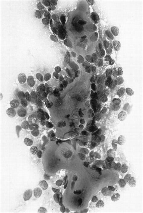 Malignant Ovarian Sex Cord Tumor With Annular Tubules In A Patient With