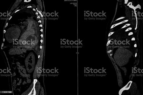 Computer Tomography Angiography Cta Of Whole Body Scan With 3d Reconstruction Ct Angiography For