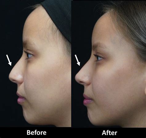 Improve The Appearance Of Your Nose