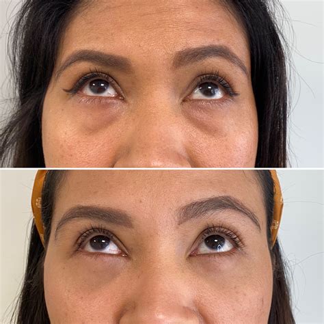 Blefaroplastia cirugía estética de párpados Barcelona