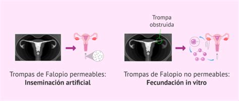 Qué es la histerosalpingografía Indicaciones y resultados