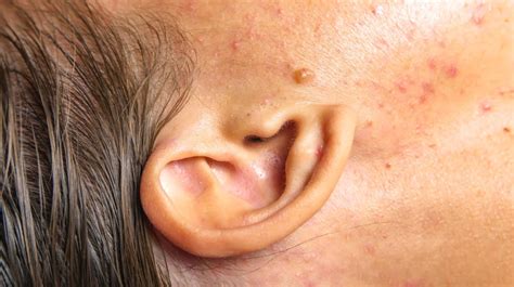 Swollen Lymph Nodes Behind Ear