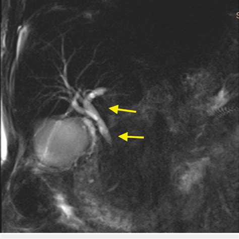 Mri Of The Abdomen And Pelvis Showing Intrahepatic Bile Duct Dilation Hot Sex Picture