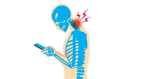 Text Neck Syndrome - Cause, Symptoms, Treatment, Exercise