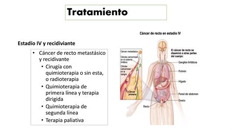 Caso Cl Nico C Ncer De Recto Ppt