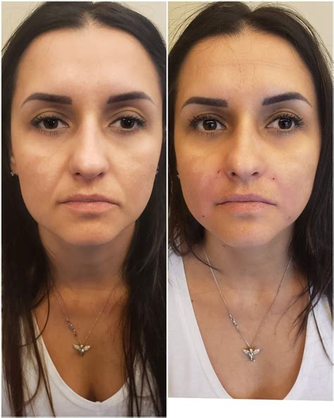 Nasolabial Fold Filler Doctor Led Aesthetic Clinic London Beauty Clinic