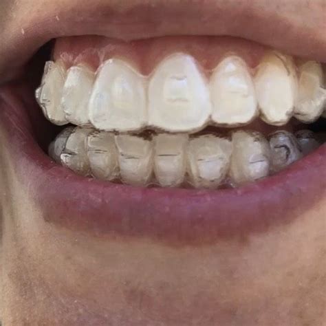 Invisalign De Cerca Con Muchos Ataches La Ortodoncia