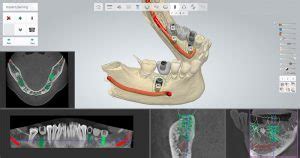 Planificaci N En D Y Cirug A Guiada De Implantes Cl Nica Dental Dr