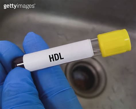 Blood Sample For HDL C HDL Cholesterol Test Cardiovascular Risk