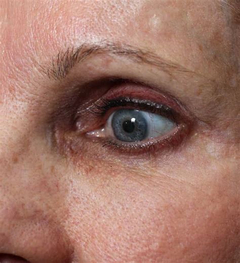 Can Upper Blepharoplasty Go Wrong Dr Prasad Blog