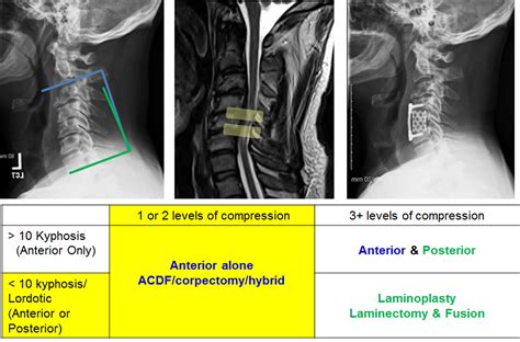 Cervical Myelopathy Spine Orthobullets