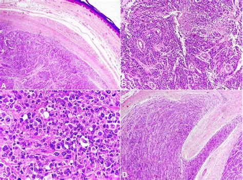 Photomicrographs Of The Tumor A Shows A Well Circumscribed Tumor