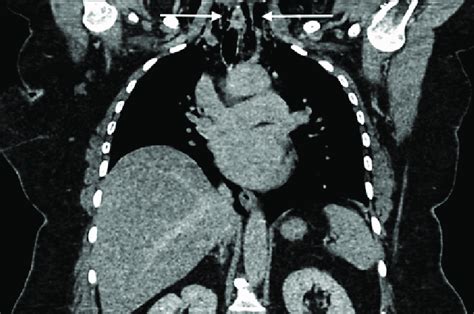 Coronal CT scan of the chest showing pneumomediastinum. White arrows ...