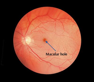 Macular Hole