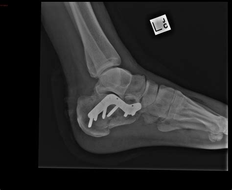 Calcaneal Fracture Wikidoc