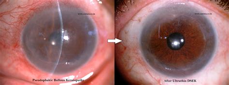 Dsek Cornea