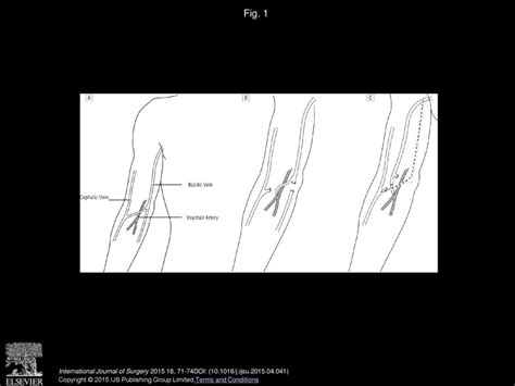 A Comparison Between One Stage And Two Stage Procedures For The