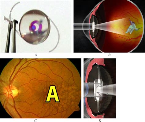 Figure 1 From Mirror Telescopic Intraocular Lens For Agerelated