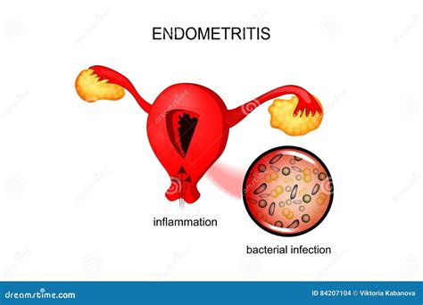 The Uterus Affected By Endometriosis Stock Vector Illustration Of