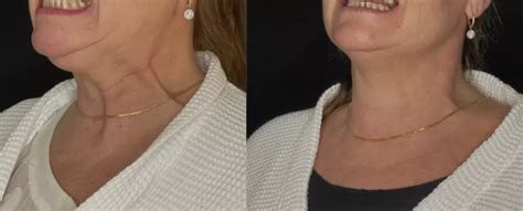 Before And After Nefertiti Neck Lift Treatment | Viva Eve