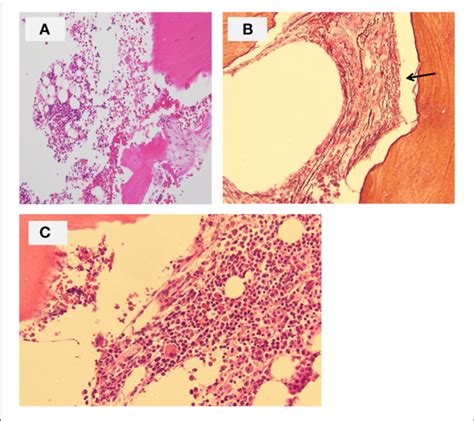 Bone Marrow Biopsy Of The Patient A Hematoxylin And Eosin Section