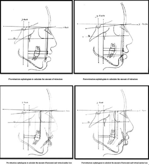 Pre And Post Cephalometric Tracings Download Scientific Diagram