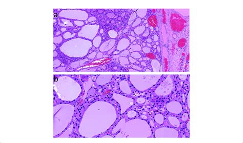 Thyroid Adenoma Histology