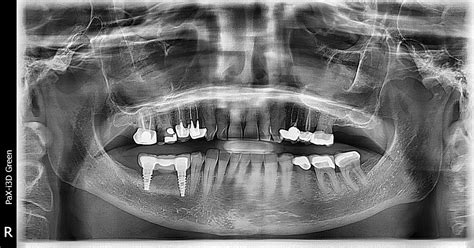 Implant-Supported Bridge with Bone Loss: How would you treat this?