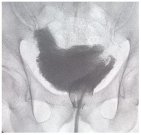 Robot Assisted Radical Cystectomy A Single Center Experience And A