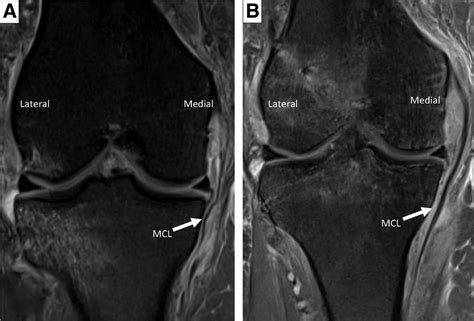 Magnetic Resonance Imaging Of Patients Right Knee A Preoperative