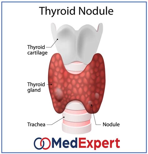 Thyroid Nodules Treatment Causes And Symptoms Med Expert