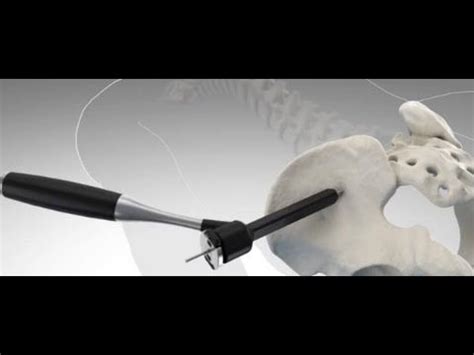 Sacroiliac Joint Fusion Surgery Video Ifuse Implant System Procedure