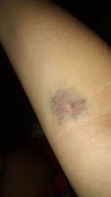 Braço Roxo E Inchado - Meninas o braço de vocês tbm fica roxo, inchado e dolorido | BabyCenter