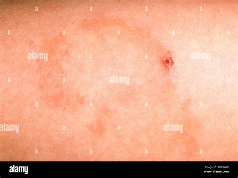 A Close Up Photograph Of Granuloma Annulare A Long Term Chronic Skin