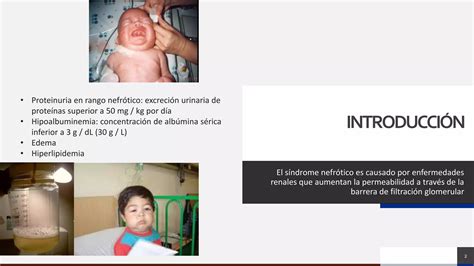 Síndrome Nefrótico en Niños PPT Descarga Gratuita