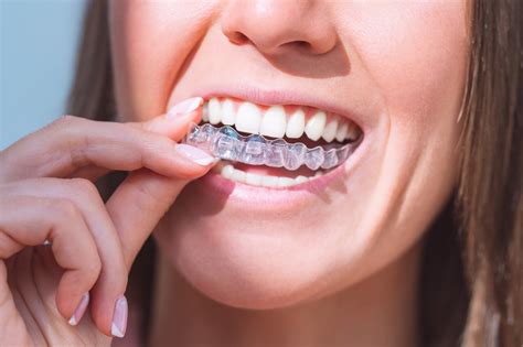 Pdl Health During Clear Aligners Treatment My Line Aligner