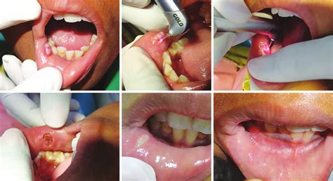 A To F Mucocele Excision A Preoperative View Showing Mucocele