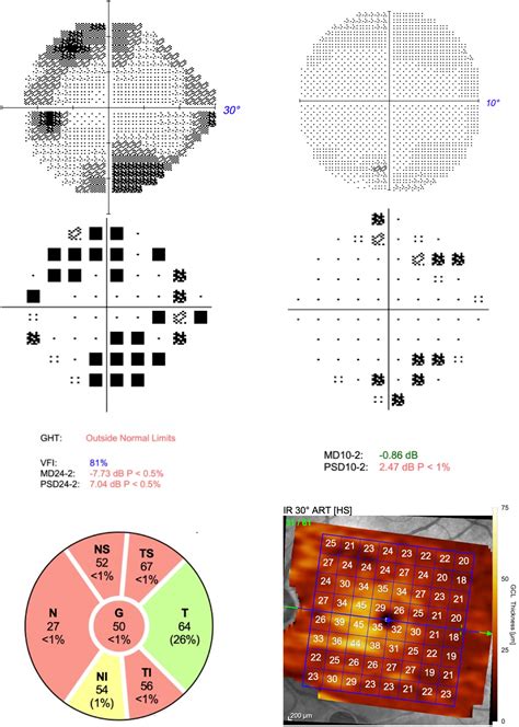 Comparison Of And Perimetry To Diagnose Glaucoma Using Oct As