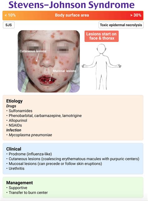 emDOCs.net – Emergency Medicine EducationEM@3AM: Stevens-Johnson ...