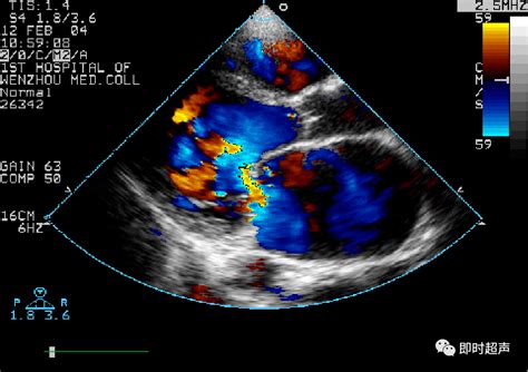 心脏瓣膜病超声诊断二尖瓣
