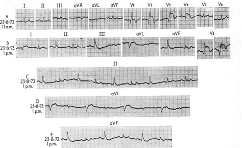 Case 7 A Acute Myocardial Infarction Of The Anteroseptal Wall Old Download Scientific Diagram