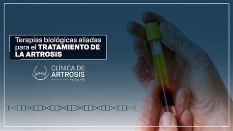 Terapias Biol Gicas Aliadas Para El Tratamiento De La Artrosis