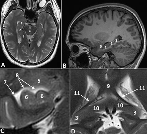 Hippo Campus Mri Sagittal