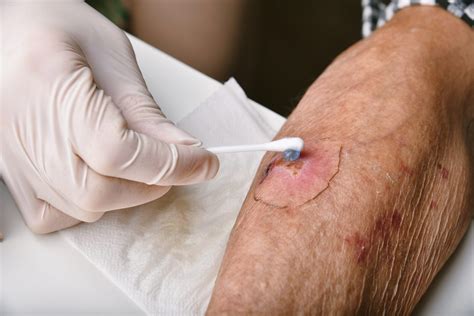 Different Types Of Wound Dressings And When To Use Them