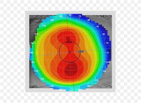 Corneal Topography Keratoconus Contact Lenses Optometry, PNG, 600x600px ...